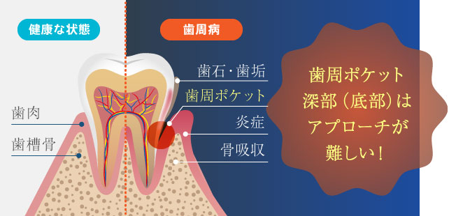 歯周ポケット深部（底部）はアプローチが難しい！