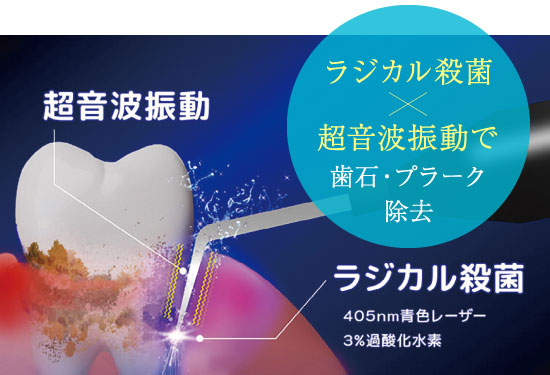 ラジカル殺菌×超音波振動で歯石・プラーク除去