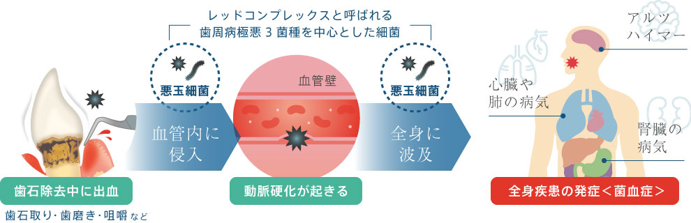 歯石除去中に出血し「悪玉細菌」が血管内に侵入すると、悪玉細菌が全身に波及し全身疾患を発症する「菌血症」となる場合があります。
