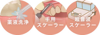 薬液洗浄、手用スケーラー、超音波スケーラー