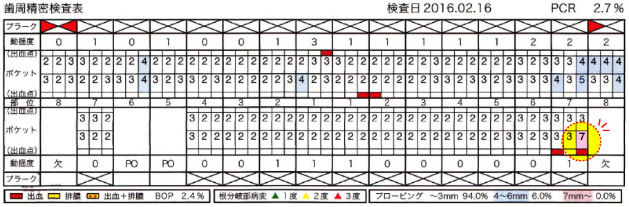 治療開始から2週間後の歯周精密検査表