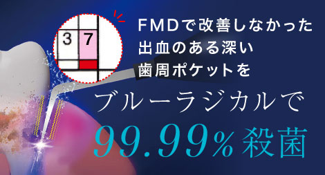 FMDで改善しなかった出血のある深い歯周ポケットをブルーラジカルで99.99%殺菌