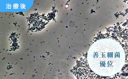 治療後：善玉細菌優位