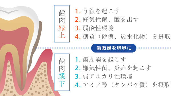 歯肉縁上／歯肉縁下