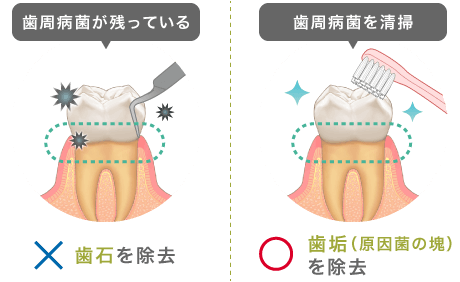 歯石ではなく歯垢を除去することが大切です