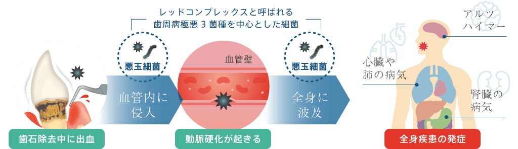 全身への健康被害 大阪で歯周病治療なら 中垣歯科医院