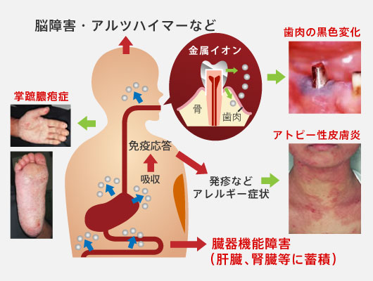 歯科金属から金属イオンが溶解し全身の病気に繋がります