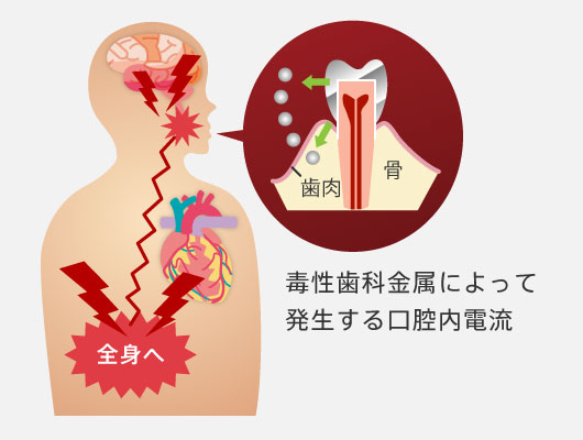 毒性歯科金属によって発生する口腔内電流が全身に悪影響を与えます