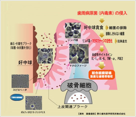 歯周病原菌（内毒素）の侵入