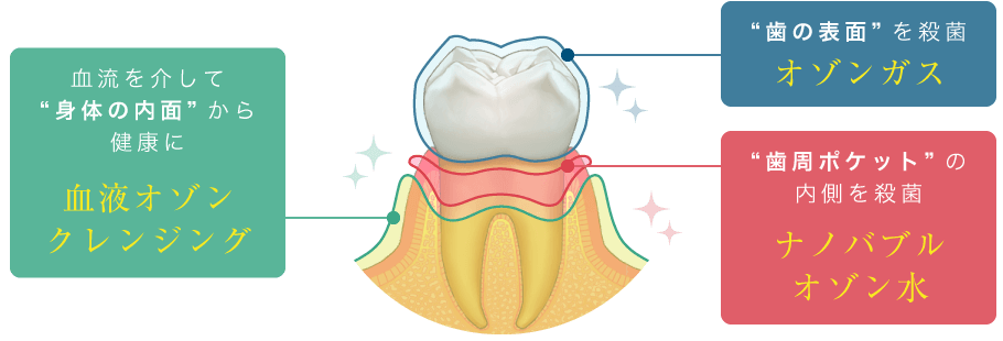 血流を介して“身体の内面”から健康に：血液オゾンクレンジング、“歯の表面”を殺菌：オゾンガス、“歯周ポケット”の内側を殺菌：ナノバブルオゾン水