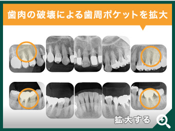 歯根が割れている抜歯適応の歯