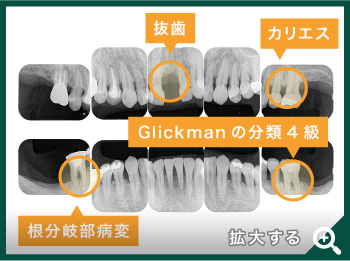 歯根が割れている抜歯適応の歯