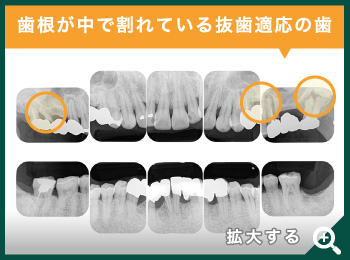 歯根が割れている抜歯適応の歯