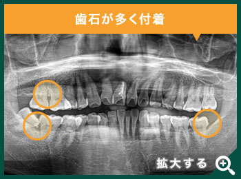 歯根が割れている抜歯適応の歯