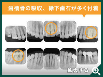 歯根が割れている抜歯適応の歯