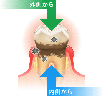 歯周病を外側からと内側から治療します