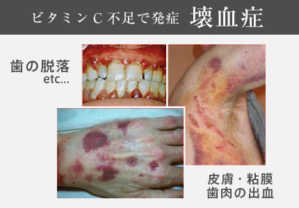 ビタミンC不足で発症 壊血症