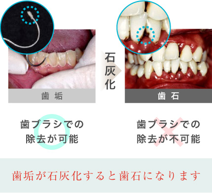 歯垢が石灰化すると歯石になります