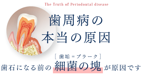 歯周病の本当の原因とは：歯石になる前の細菌の塊（歯垢=プラーク）が原因です